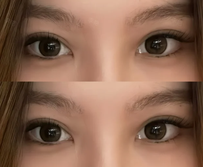 李艳双眼皮案例