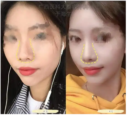 于海生隆鼻案例