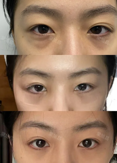 蒙旭昌祛眼袋案例