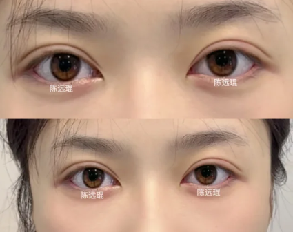 陈割双眼皮