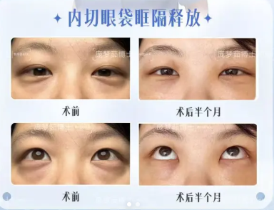 庞梦茹祛眼袋案例