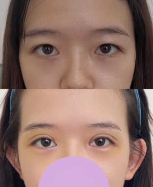 徐逸割双眼皮案例