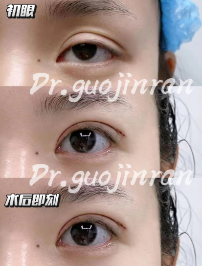 郭金冉割双眼皮案例