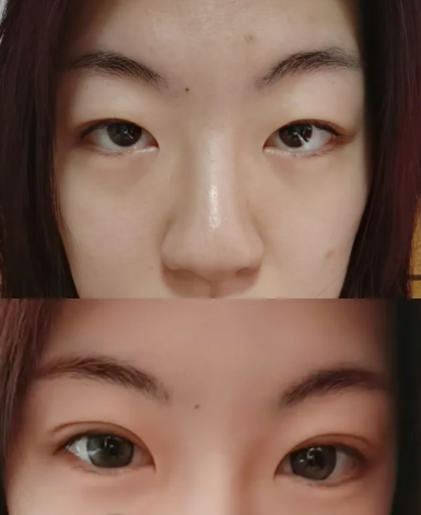 王琳双眼皮案例