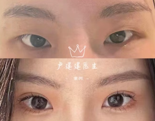 卢建建双眼皮案例