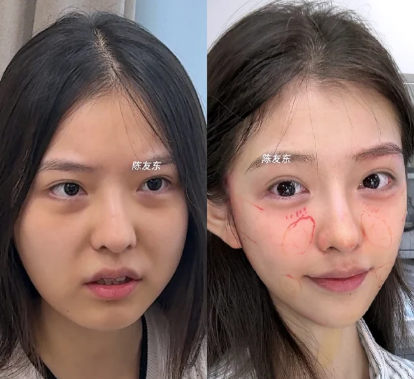 陈友东面部提升案例