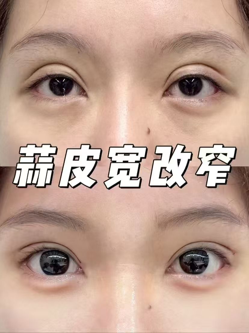 双眼皮修复