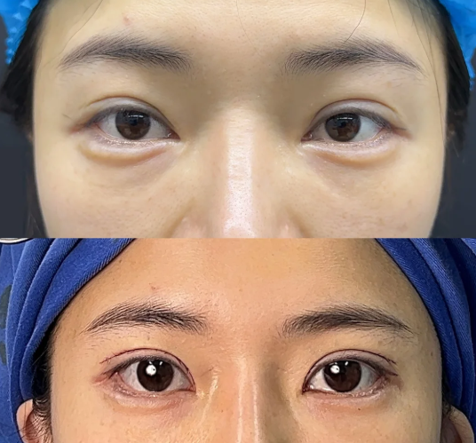 双眼皮修复