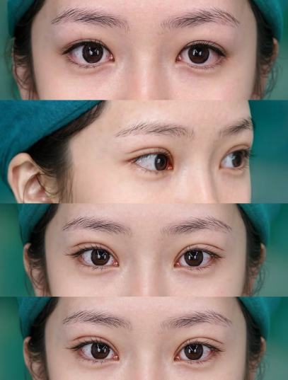 双眼皮修复