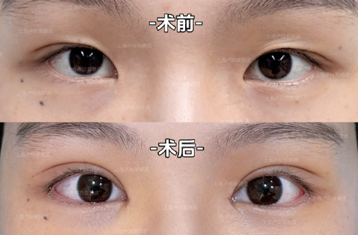 卢玲修复双眼皮案例