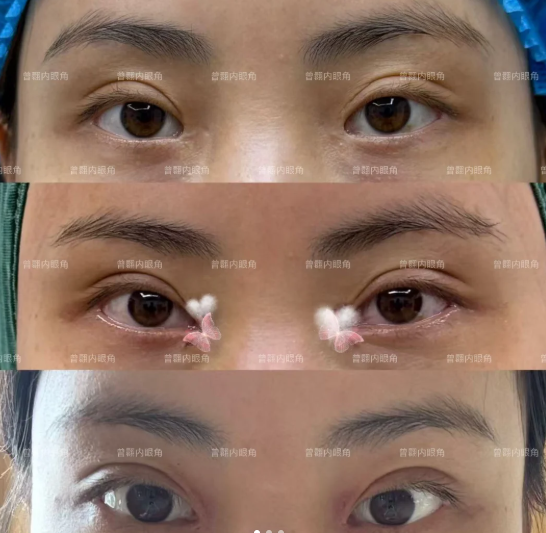 曾翾眼修复案例