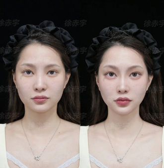 汤章明微调案例