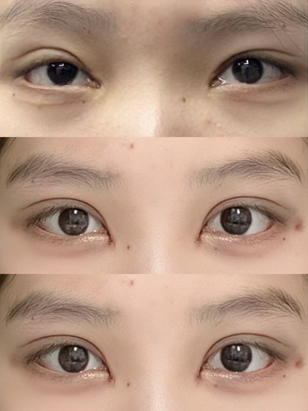上海双眼皮修复医生