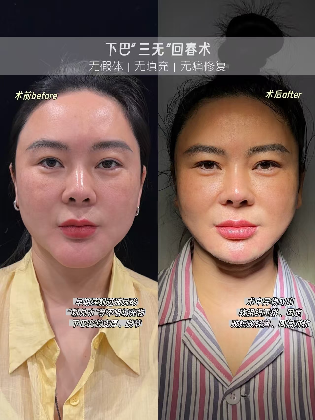 全国异物取出知名专家都有哪些？取生长因子、奥美定、不明注射物的医生哪个最好？