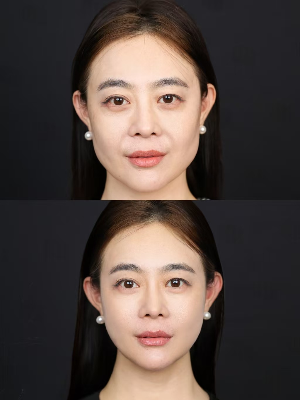 注射抗衰案例