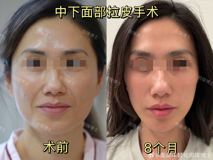 倪锋拉皮案例