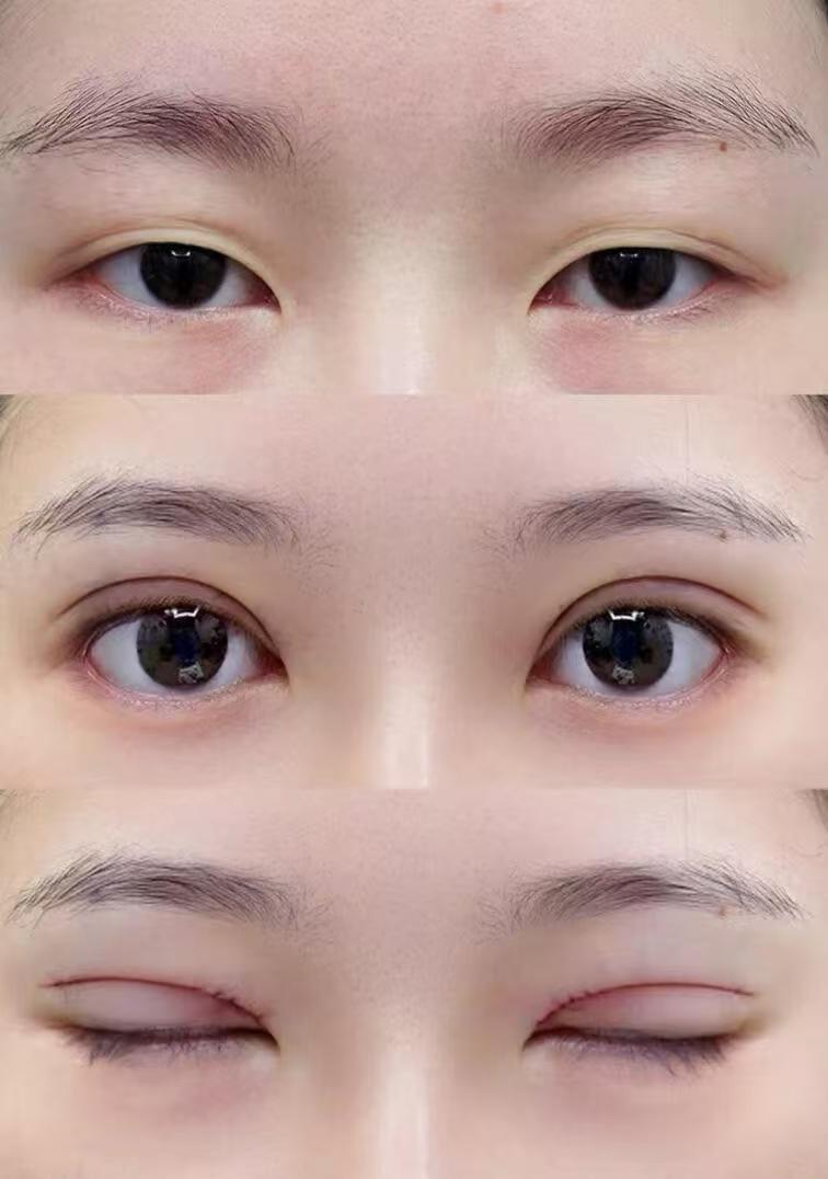 双眼皮案例