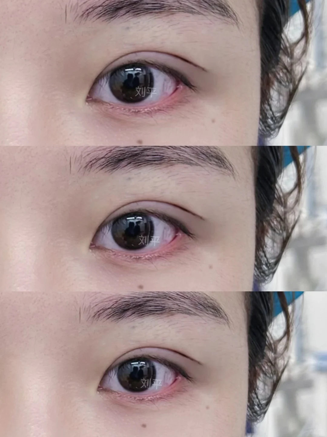 刘平眼修复案例