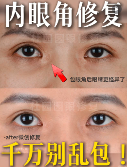 杜园园内眼角修复案例