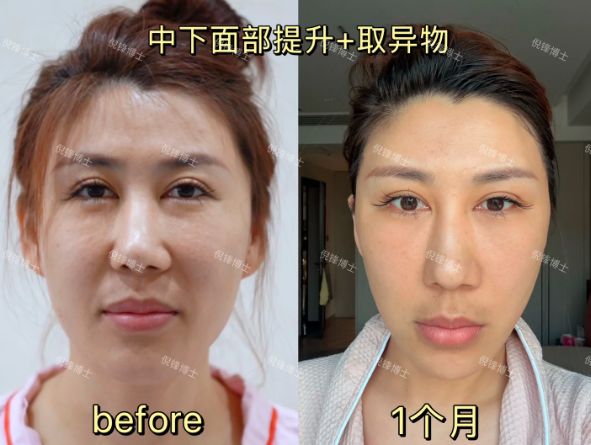倪锋面部提升