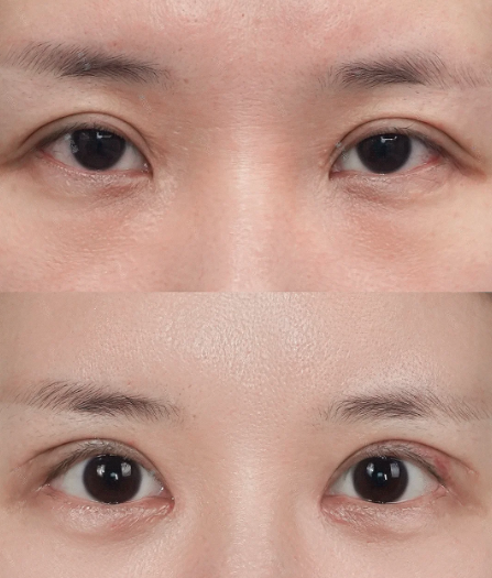 上海双眼皮修复