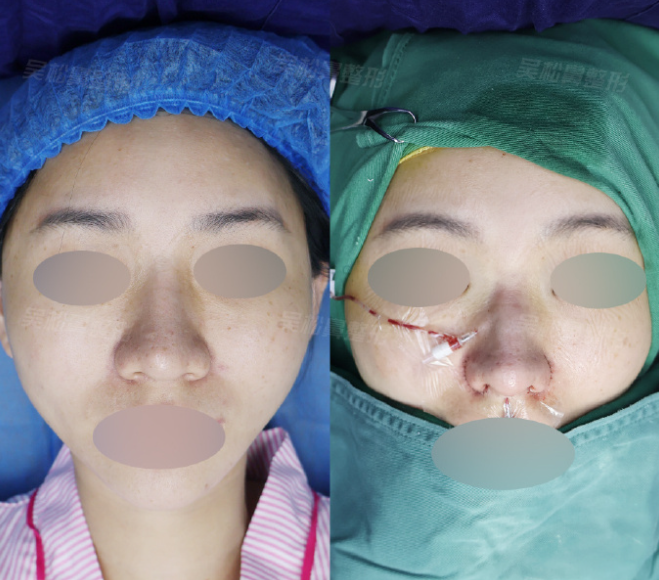 重庆吴松隆鼻怎么样？吴松鼻修复技术怎么样？口碑好不好？