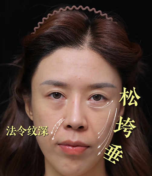 陈凤超拉皮