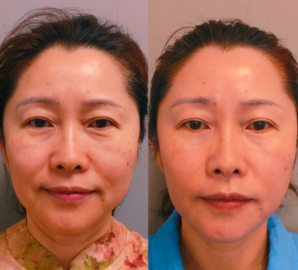 李超拉皮案例
