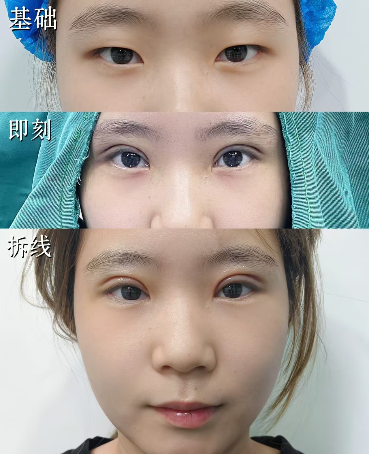 王存富双眼皮案例