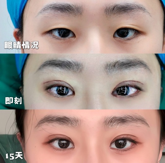 割双眼皮案例