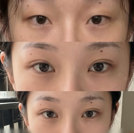 魏云玲双眼皮案例