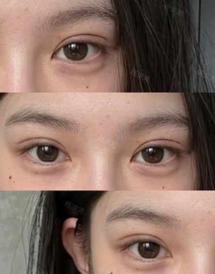 杨洪波双眼皮案例
