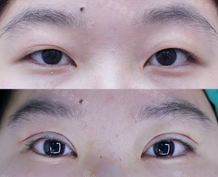 李传生双眼皮案例