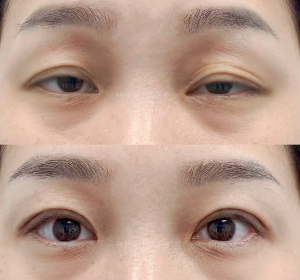 罗旭松上睑下垂矫正
