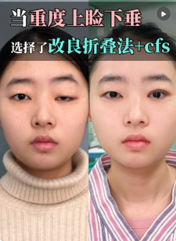 上睑下垂矫正