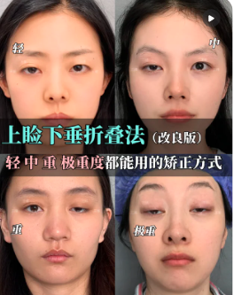王维上睑下垂矫正案例