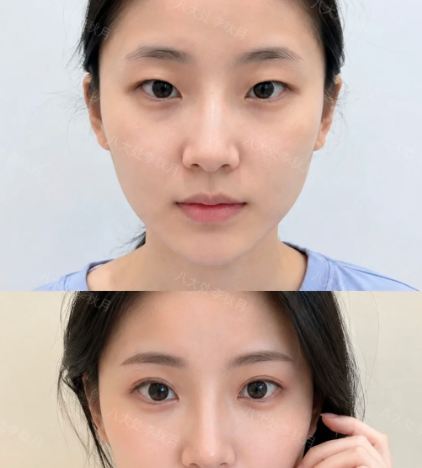 李秋月双眼皮案例