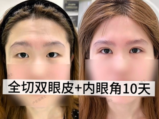 卢金强双眼皮案例