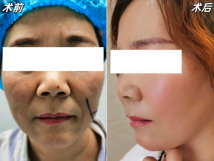 郑州拉皮医生温志华怎么样？口碑好不好？