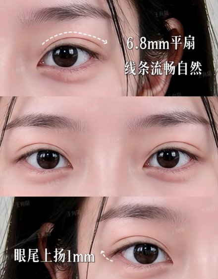 武汉双眼皮医生推荐哪个？王向阳、杨蓉、朴一飞、施俊、严飞、卓田