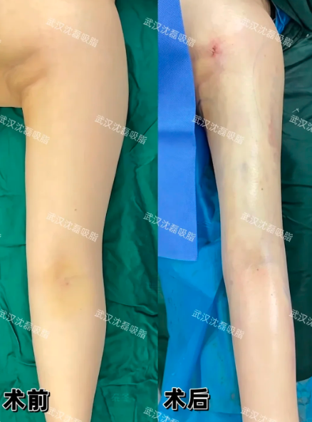 武汉吸脂好的医生是哪个？陈克、宋林章、李盛春、沈磊、包涛