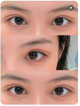 双眼皮案例