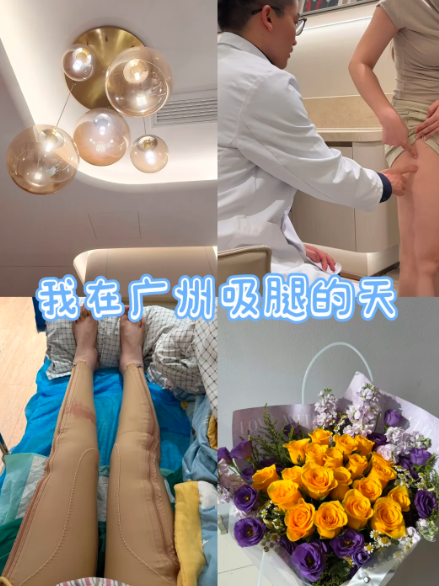 广州吸脂医生