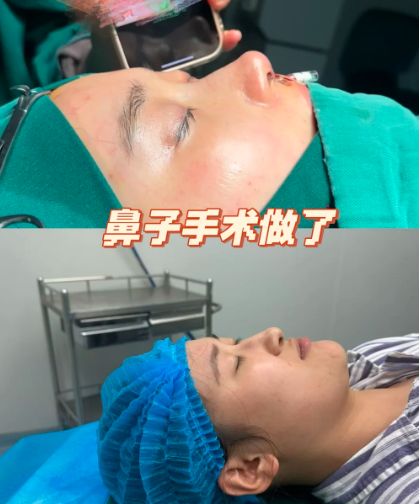 隆鼻