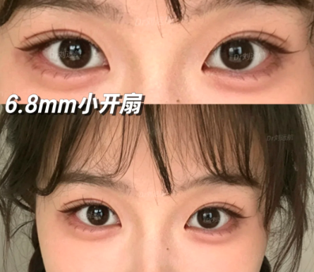 乌鲁木齐双眼皮
