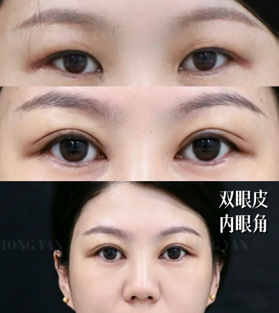 长春双眼皮