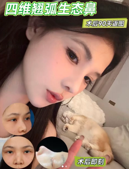 肖强隆鼻案例