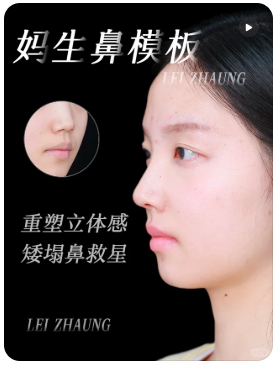 隆鼻案例
