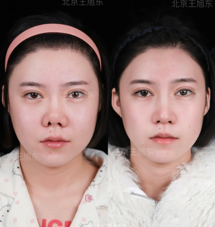 王旭东鼻修复案例