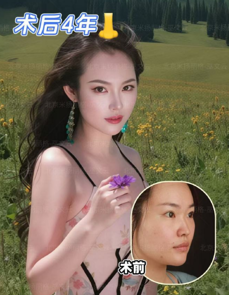 巫文云鼻修复案例